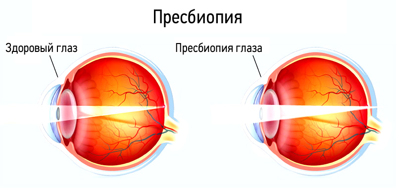 1545161000_presbiopiya.jpg