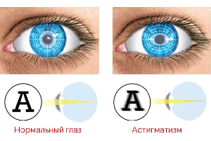 slozniy-astigmatizm.png