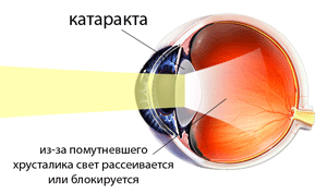 катаракта.png