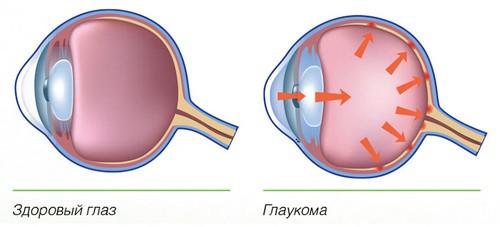 glaukoma_3.jpg